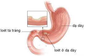 Món ăn, bài thuốc cho người bệnh dạ dày