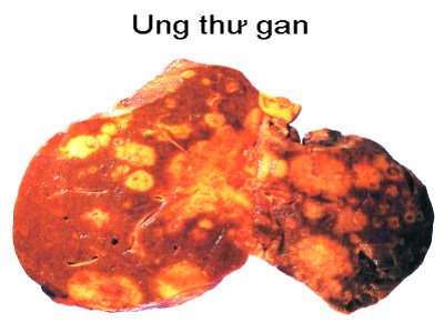 ung thu gan